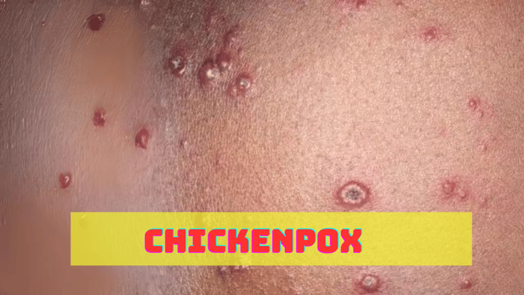 chickenpox