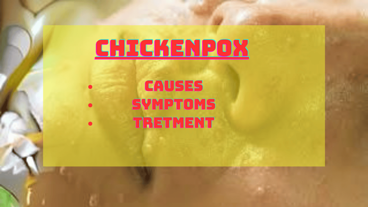 chickenpox